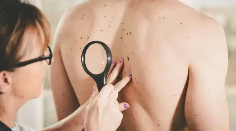 cancer de la peau prévention